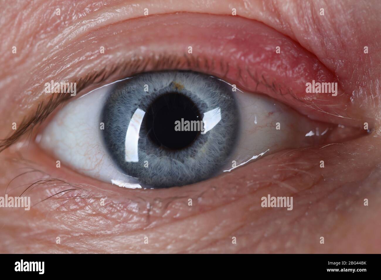 Sty on human eye closeup skin disease Stock Photo