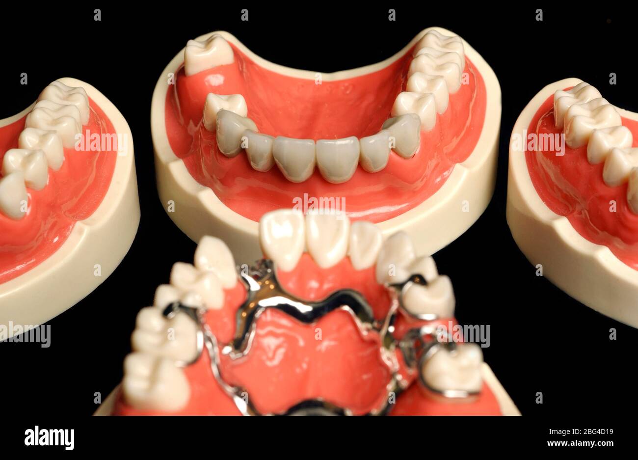 A set of dentures, one of the dentures contains a metal brace which, is