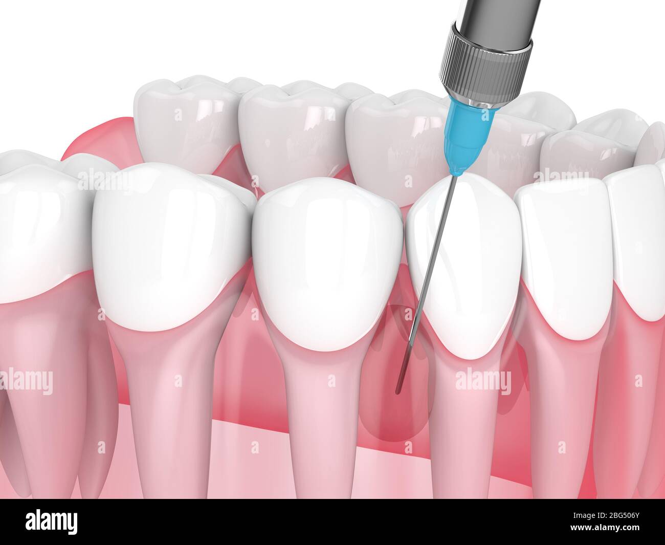 3d render of lower jaw and syringe with dental anesthesia. Dental