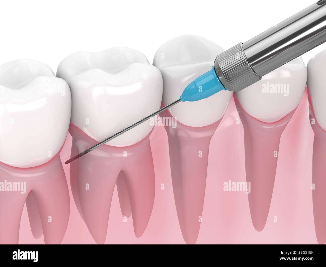 3d render of gums and syringe with dental anesthesia. Dental treatment