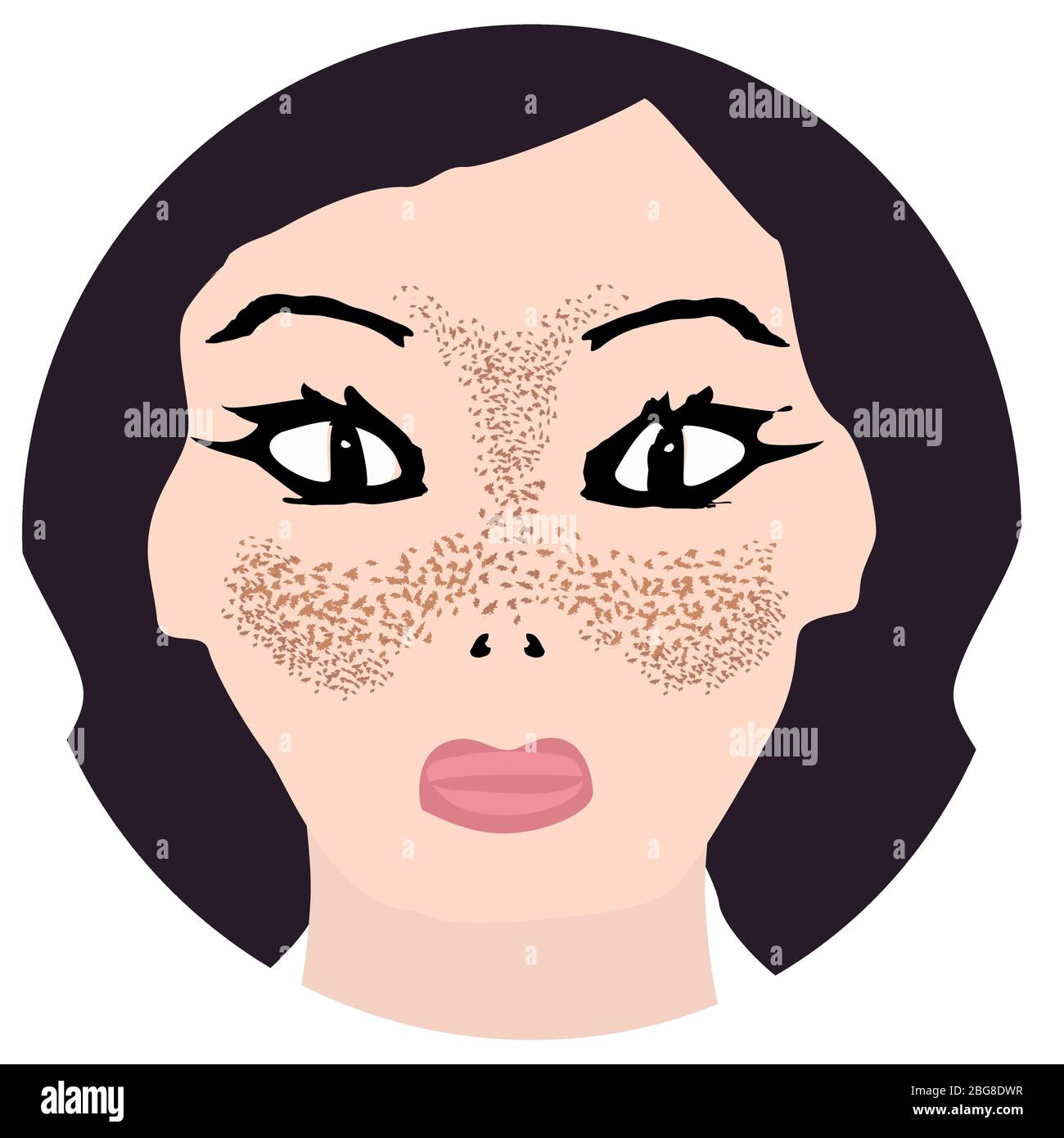 Freckles on the face. Pigmentation on the skin. A pigmented spot on the skin of the face. Before