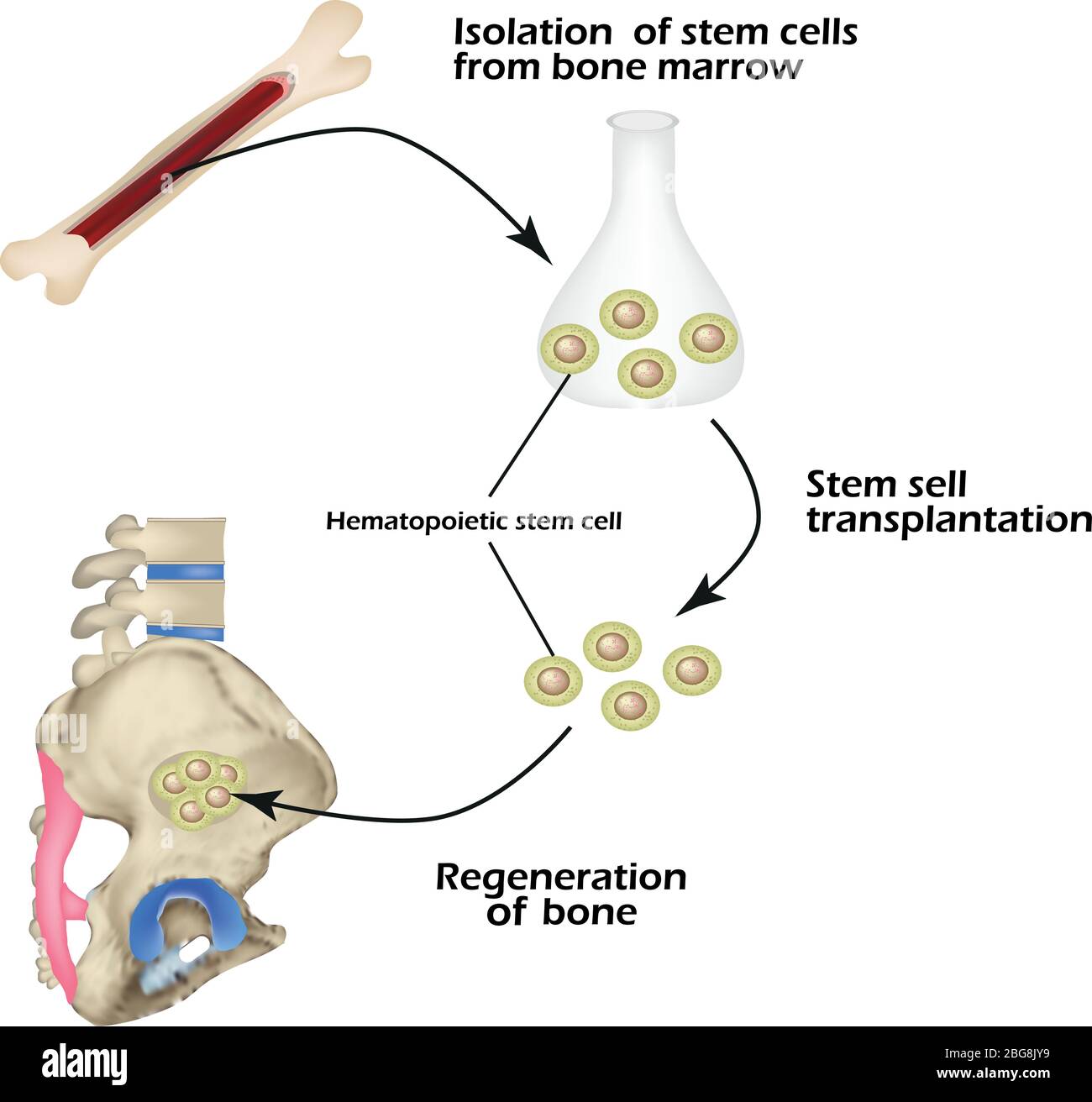 Stem cells from bone marrow are used for bone regeneration. Infographics. Vector illustration Stock Vector