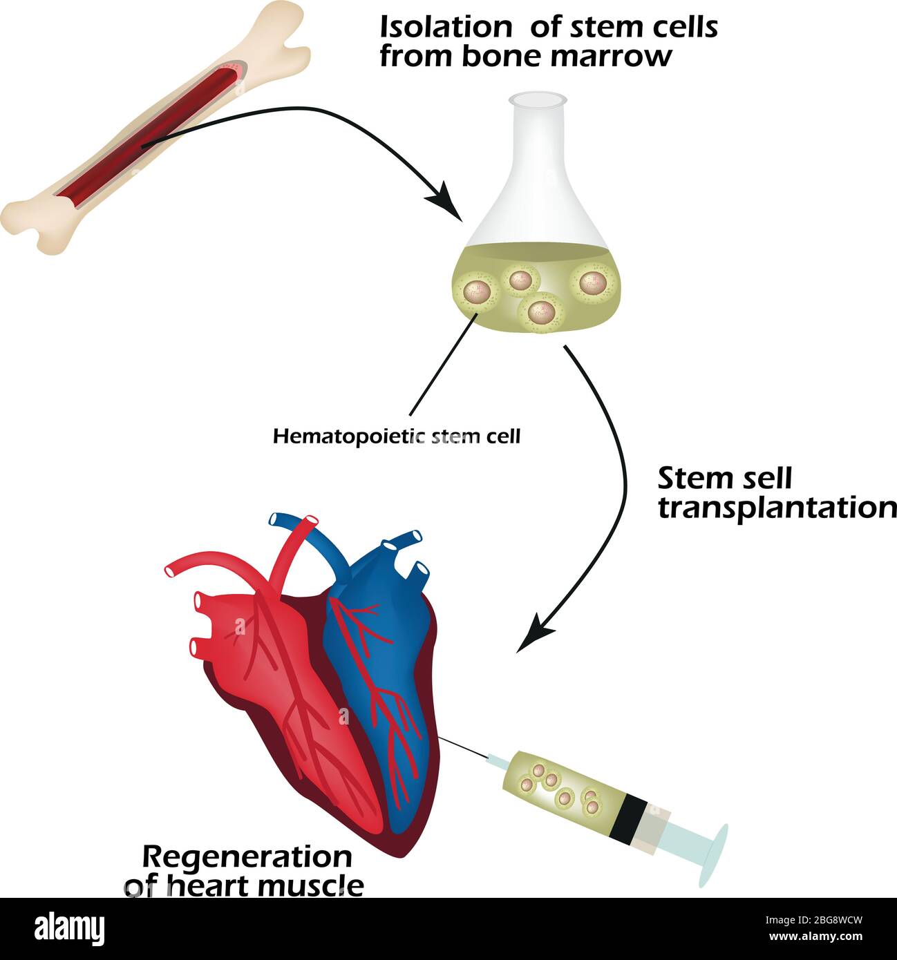 Stem cells from bone marrow is used to regenerate the cardiac muscle. Infographics. Vector illustration Stock Vector