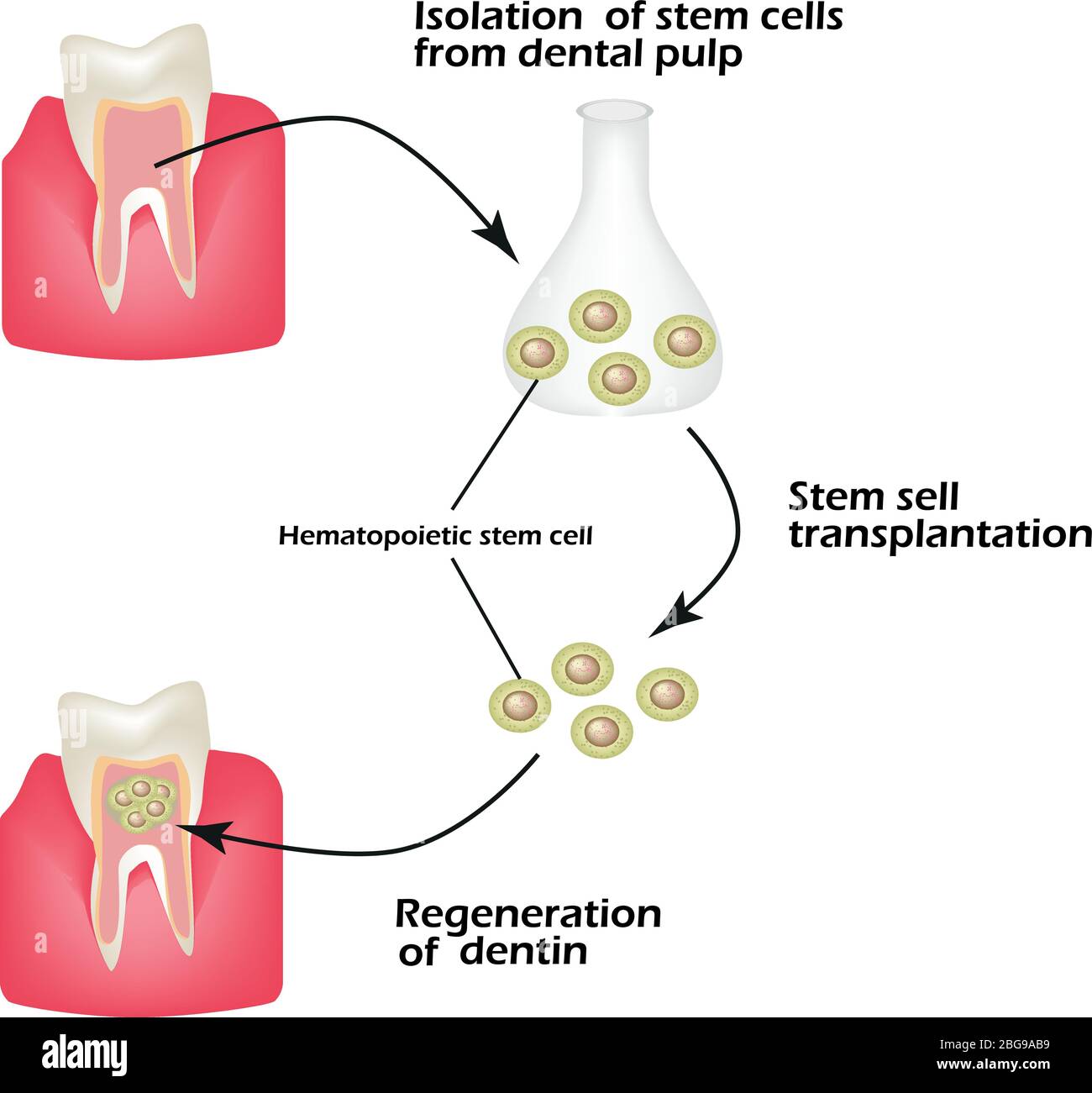 Stem cells from the dentin of the tooth is used to regenerate diseased