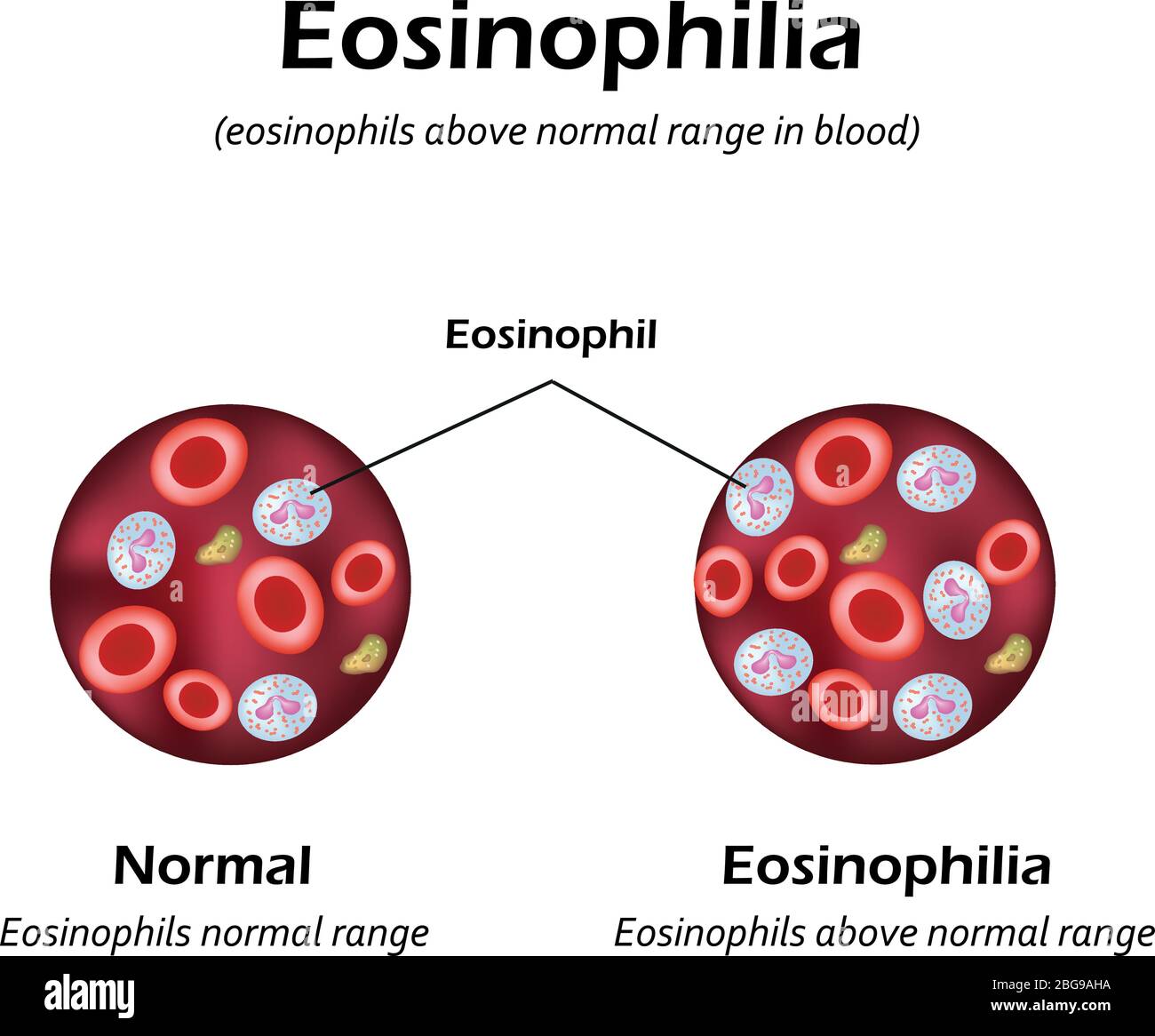 Eosinophils above normal range in blood. Eosinophilia. Infographics. Vector illustration Stock Vector