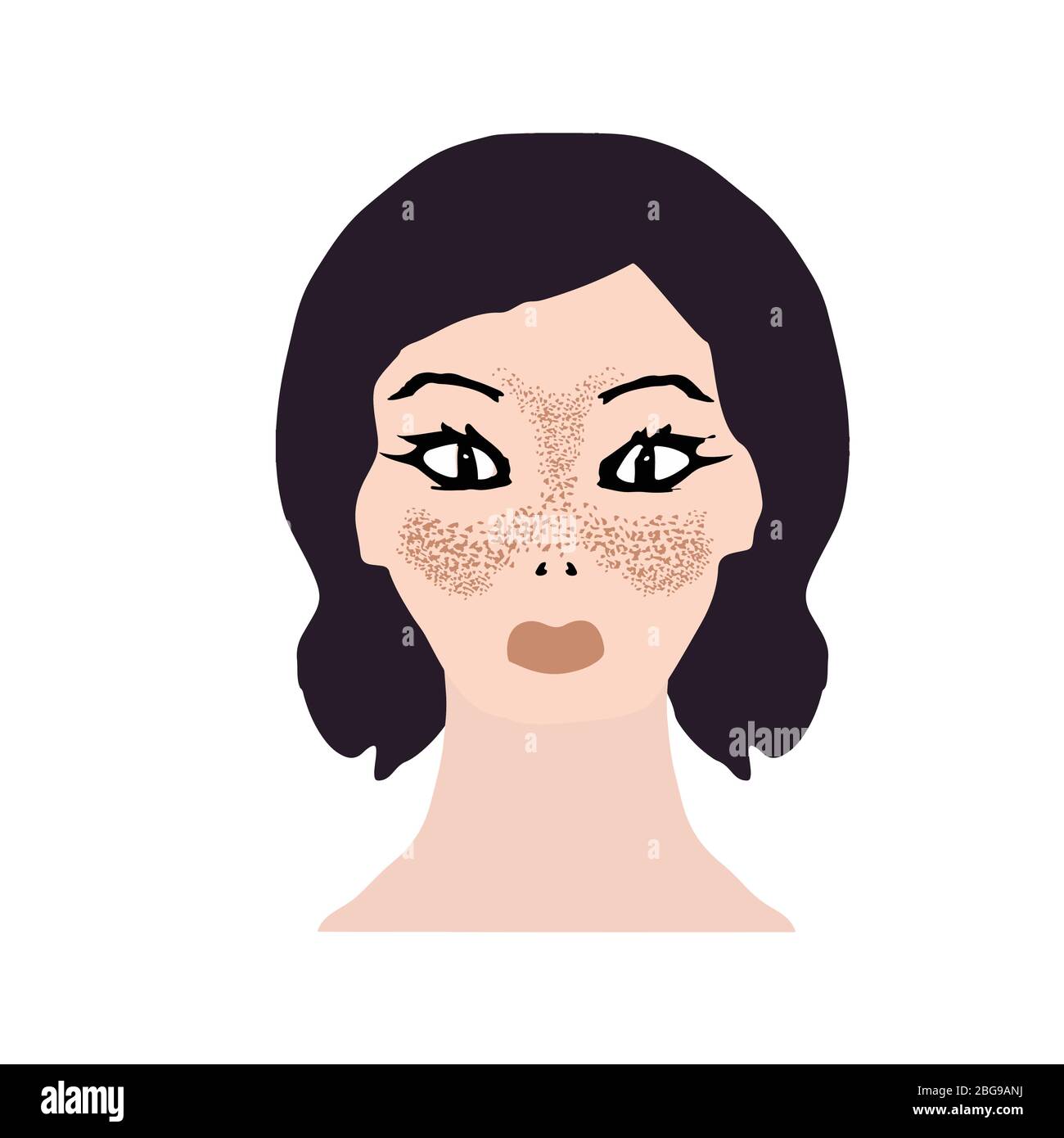 Freckles on the face. Pigmentation on the skin. A pigmented spot on the skin of the face. Before