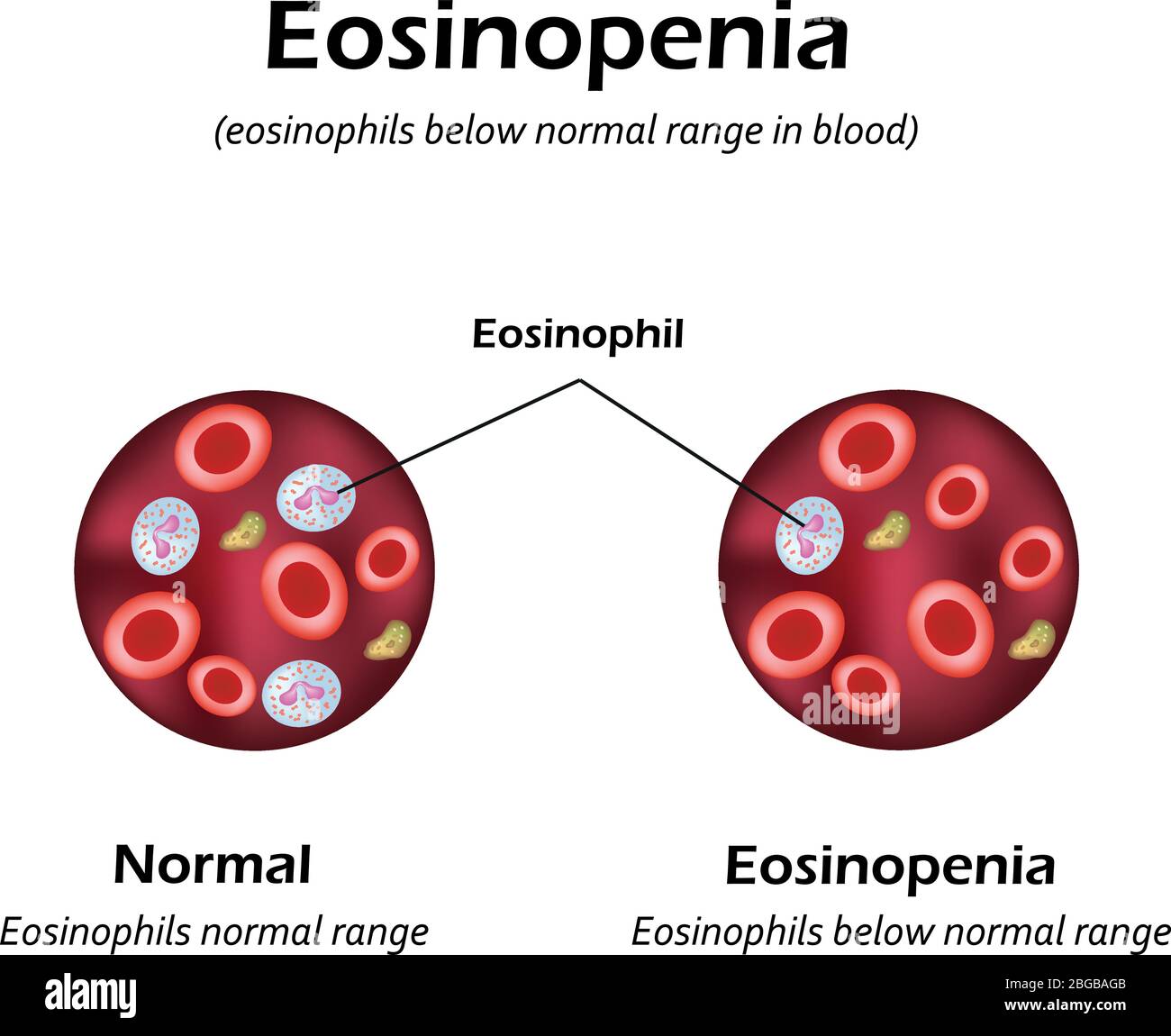 Eosinophils below normal range in blood. Eosinopenia. Infographics