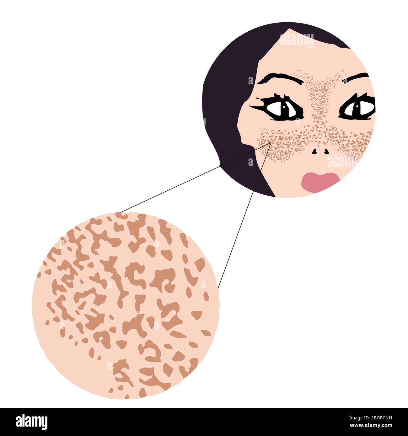 Freckles on the face. Pigmentation on the skin. A pigmented spot on the skin of the face. Vector