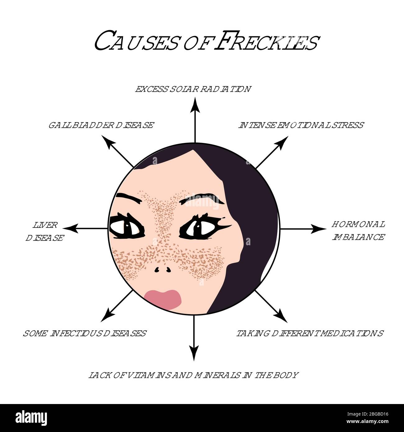 Freckles on the face of the cause. Pigmentation on the skin. A pigmented spot on the skin of the