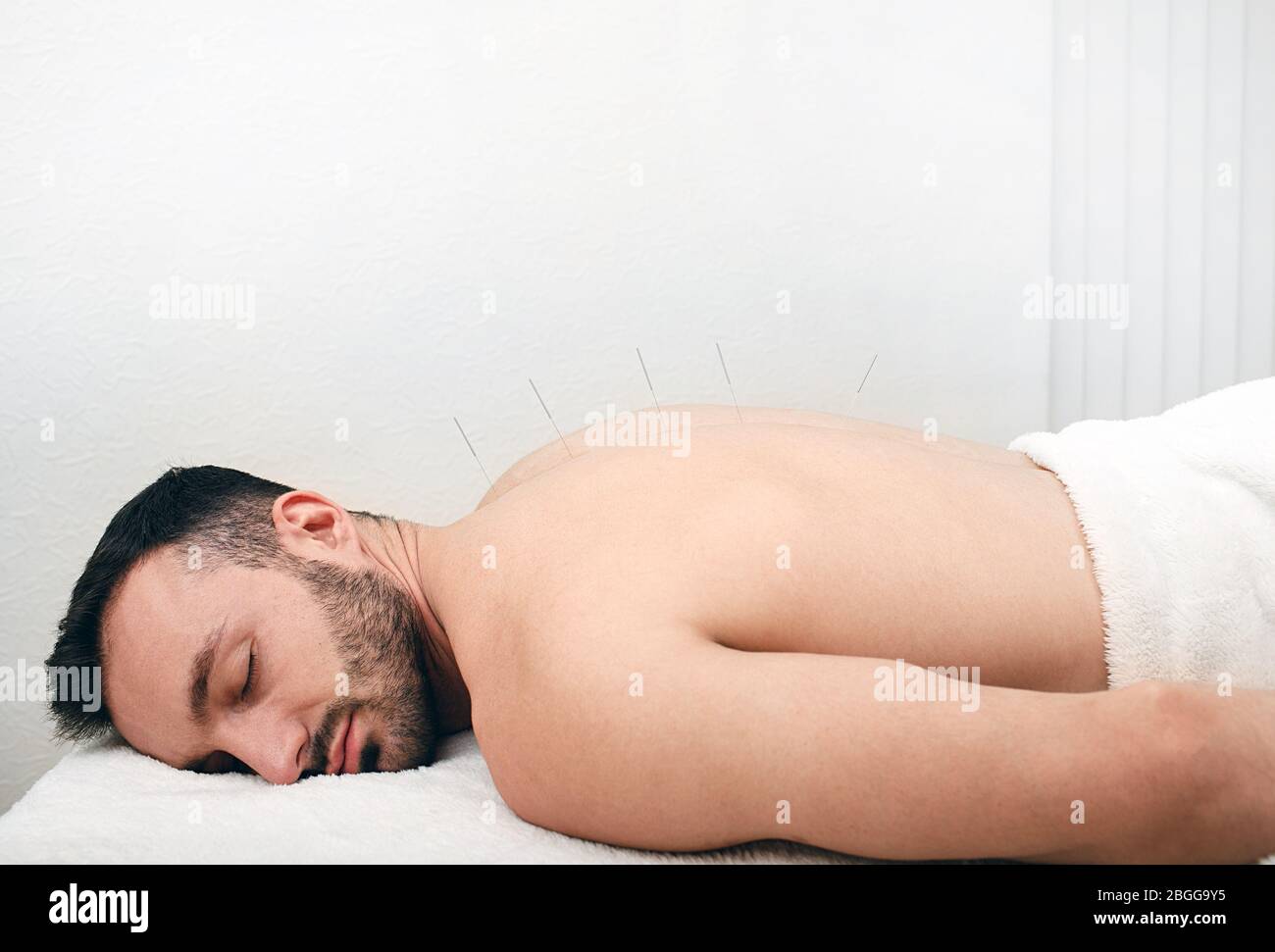 Man caucasian race getting acupuncture treatment. Acupuncture needles close up. Relax in the spa Stock Photo