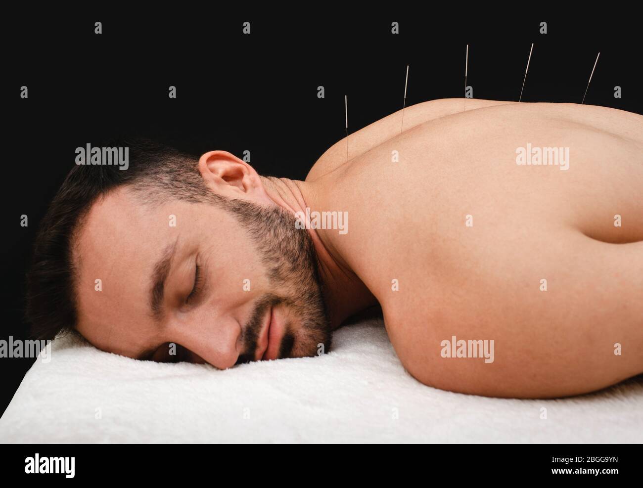 Male during acupuncture procedure. Spinal acupuncture for intervertebral hernias and protrusions. Acupuncture needles close up on black background Stock Photo