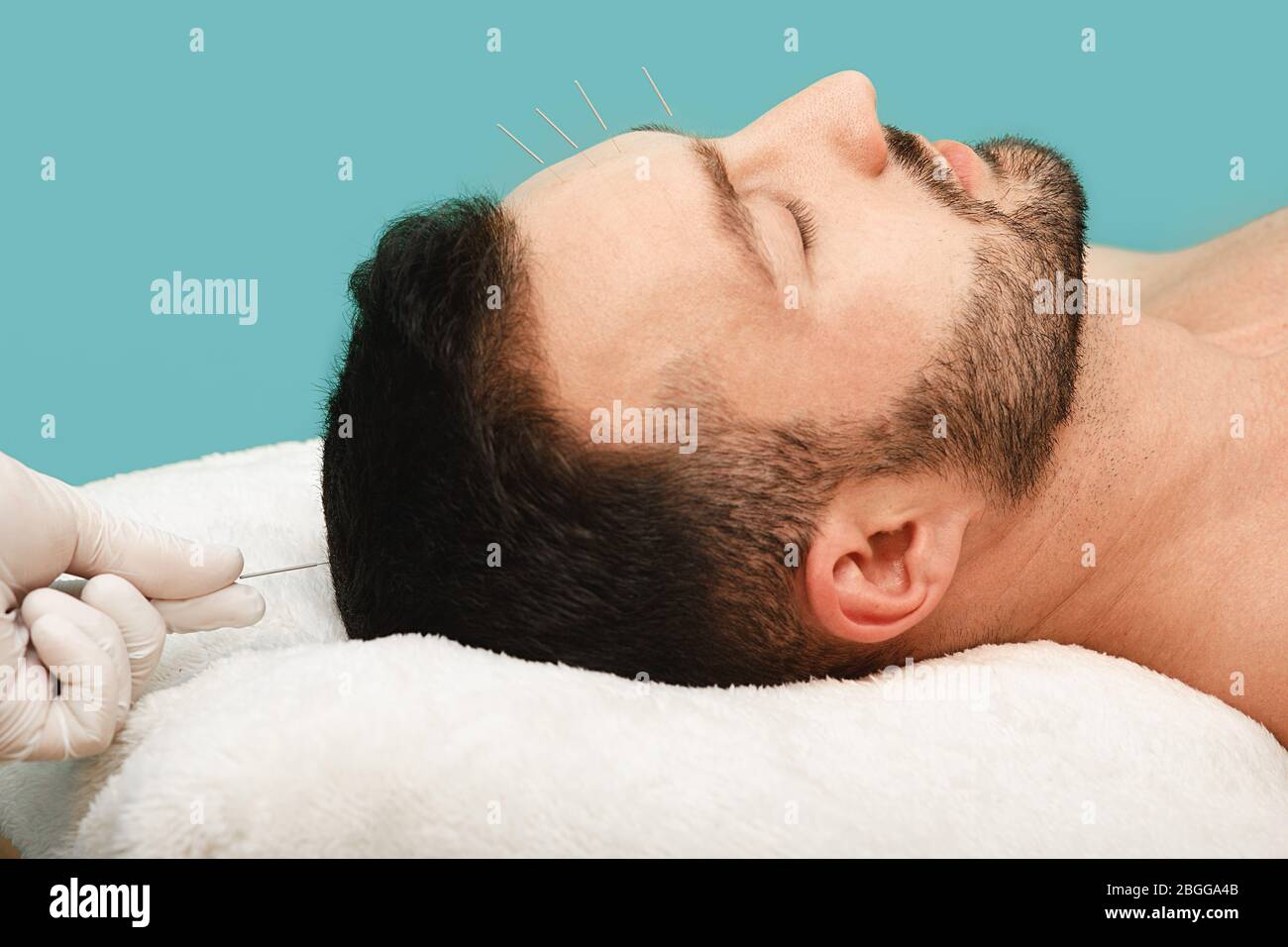 Acupuncturist inserting acupuncture needles into patients skin head