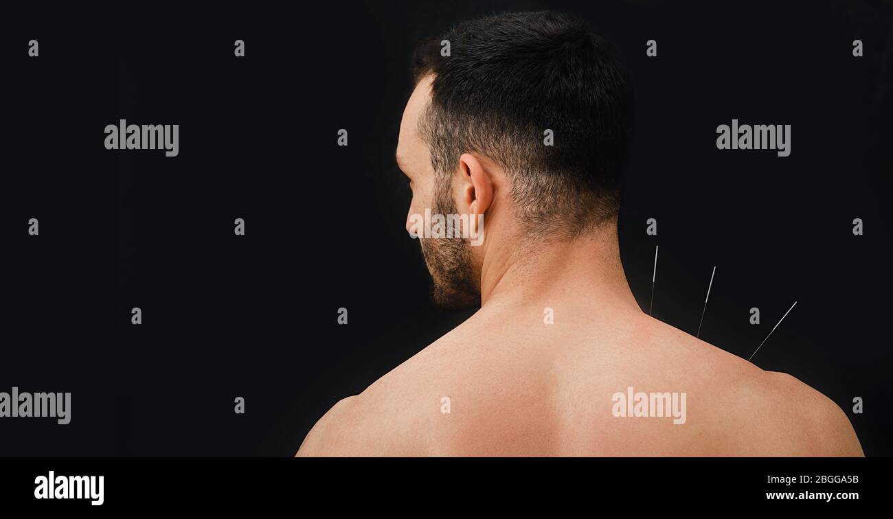 Closeup view from the back of a male patient with acupuncture needles