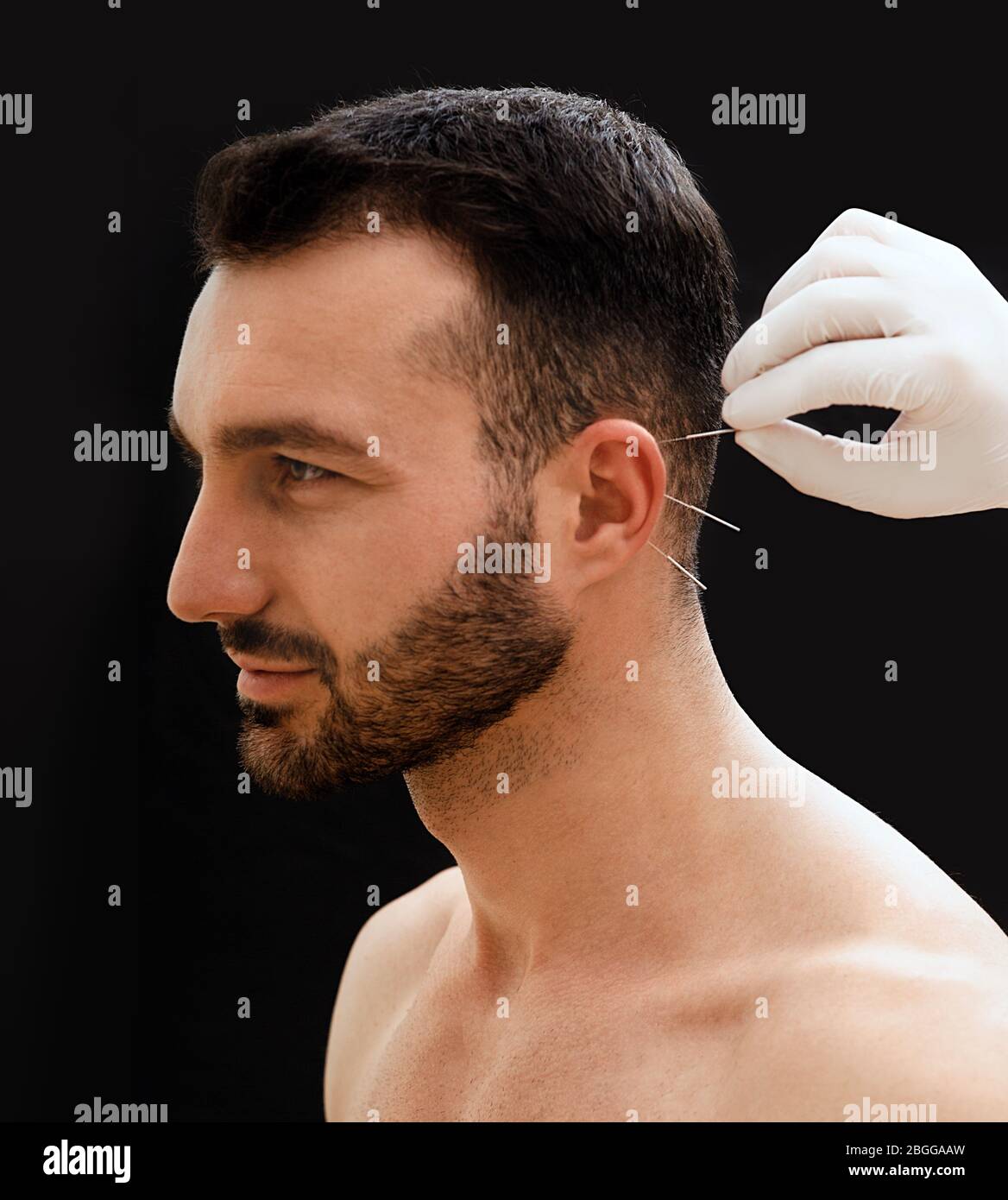 Treatment of many diseases by ear acupuncture. Acupuncturist treats a