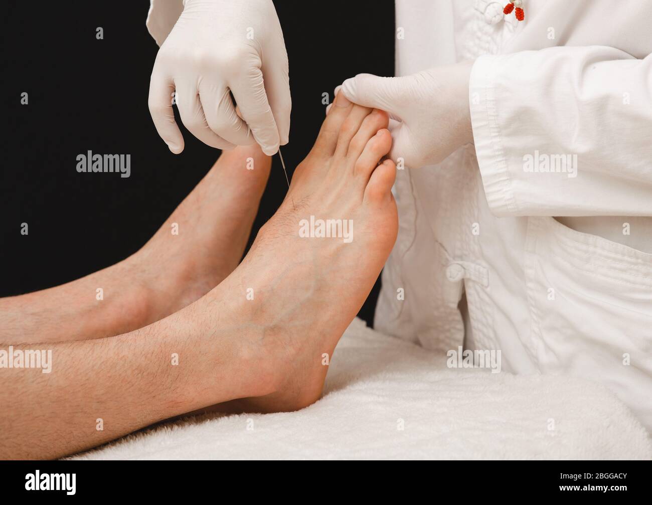 Acupuncture of human foot. Acupuncture needles close up. Acupuncture treatment for chronic pain Stock Photo