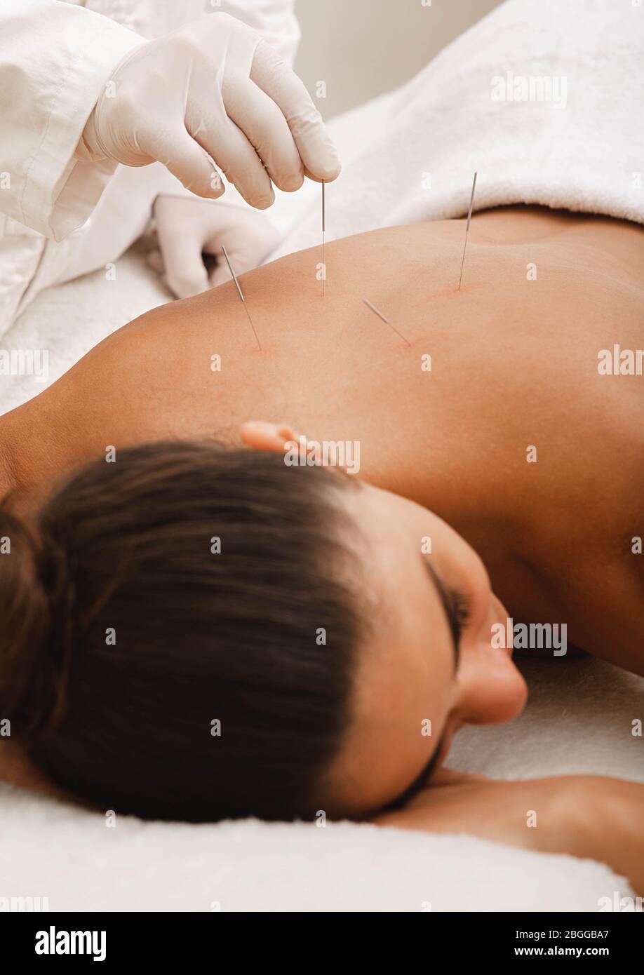 Chronic back pain of a woman is treated with acupuncture. Acupuncturist doing acupuncture very precisely at special points on his back Stock Photo