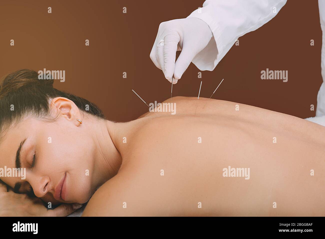 Acupunturist hand with acupuncture needle. Acupuncture treatment of chronic back pain of a woman Stock Photo