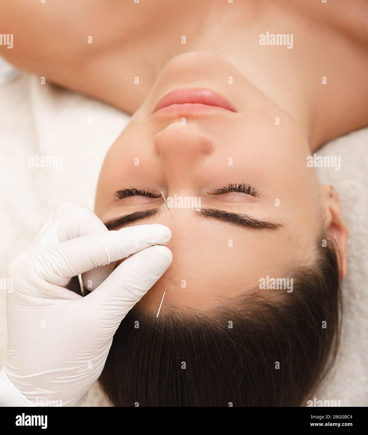 Acupuncture treatment for woman headache and migraine. Certified acupuncturist treats a woman's migraines with needles Stock Photo