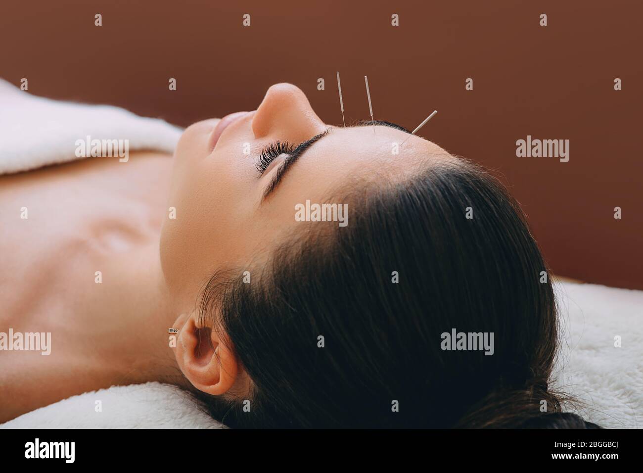 Beautiful woman received an acupuncture procedure in a spa salon. Acupuncture in the face and forehead. Acupuncture needles close-up on a brown backgr Stock Photo