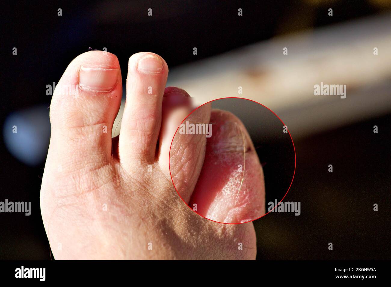 Blisters on feet hires stock photography and images Alamy