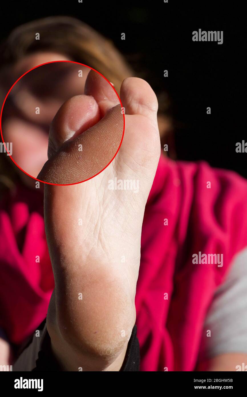 The blister feet hires stock photography and images Alamy