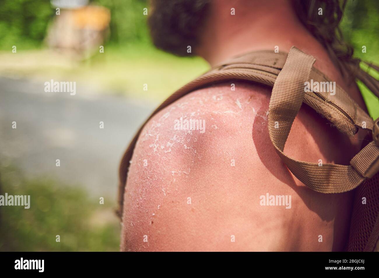 Male tourist did not use sunscreen and received a sunburn. Stock Photo