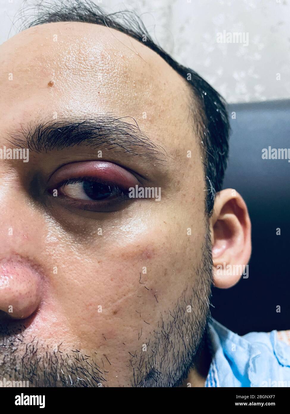 Stye Info Bump on the eyelid hi-res stock photography and images - Alamy