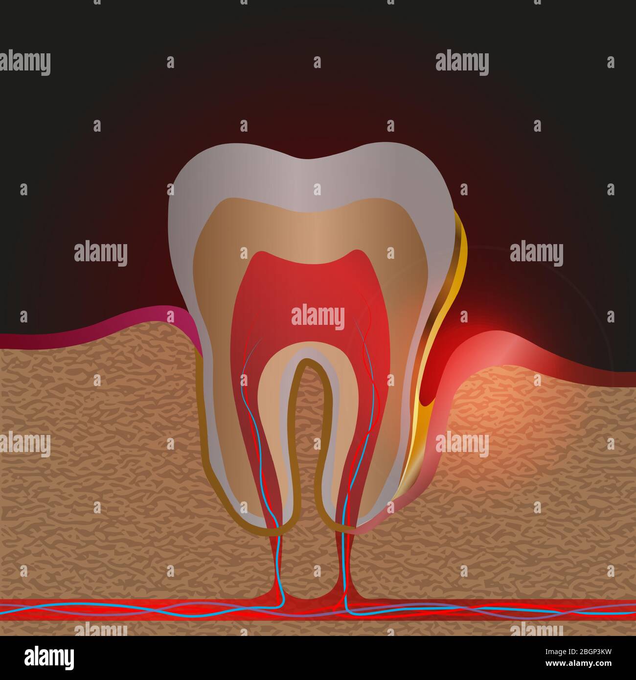 dental disease with pain and inflammation. Medical illustration of