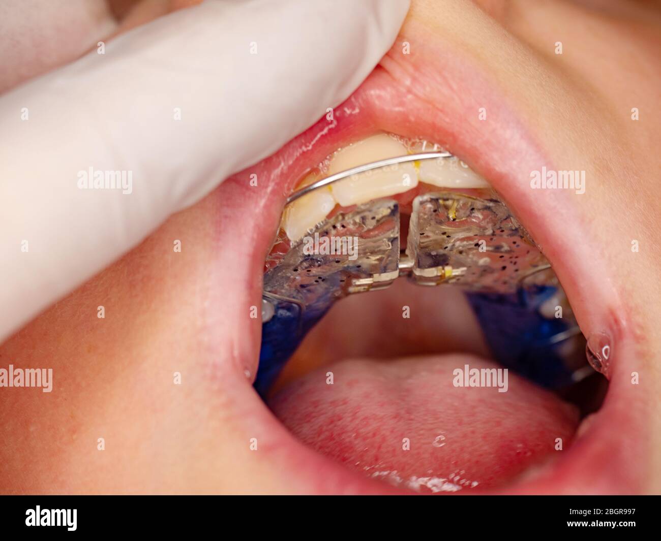 Braces Self Shot Teenage Geek Girls Braces Self Shot Teenage Geek Girls