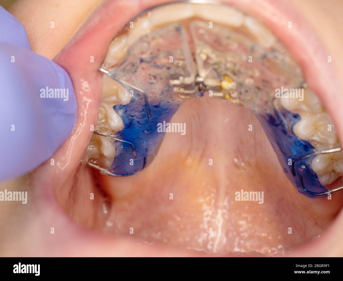 Dental treatment of adjustable braces on the teeth. Orthodontic