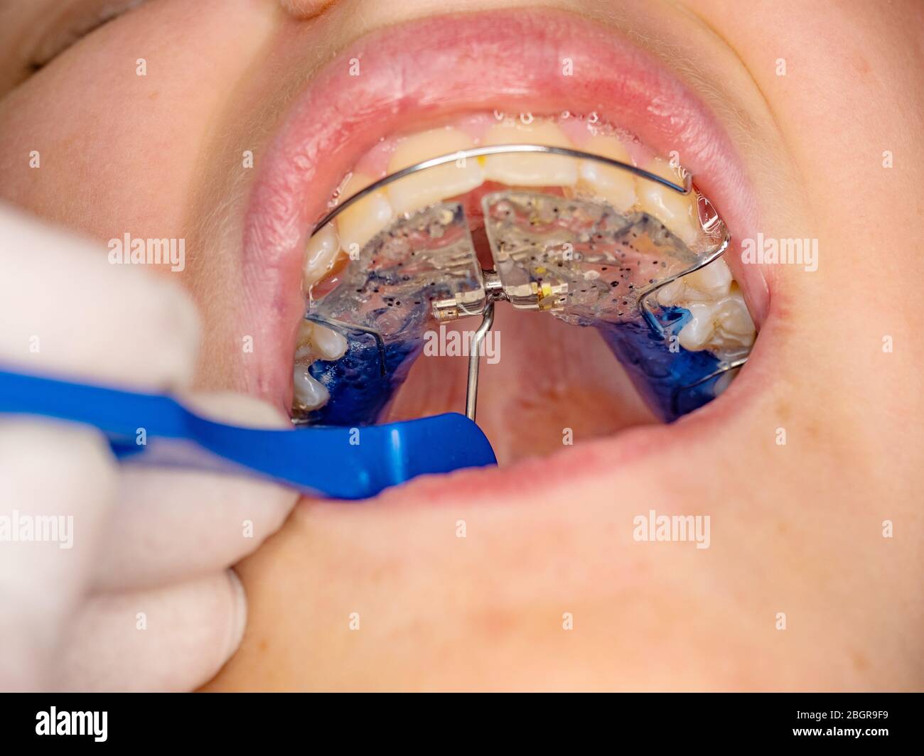 Doctor setting  with tool of Hyrax Expander RPE, Especial palatal braces for correction of birth defect. Stock Photo