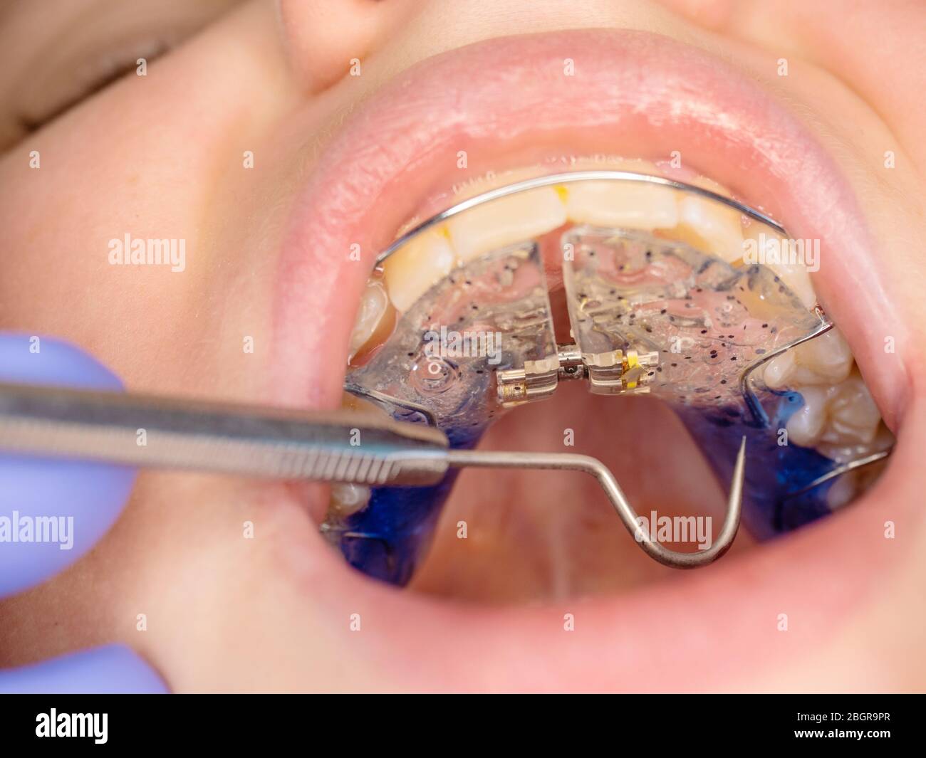 View into children mouth with white blue braces with central screw for exact setting. Stock Photo