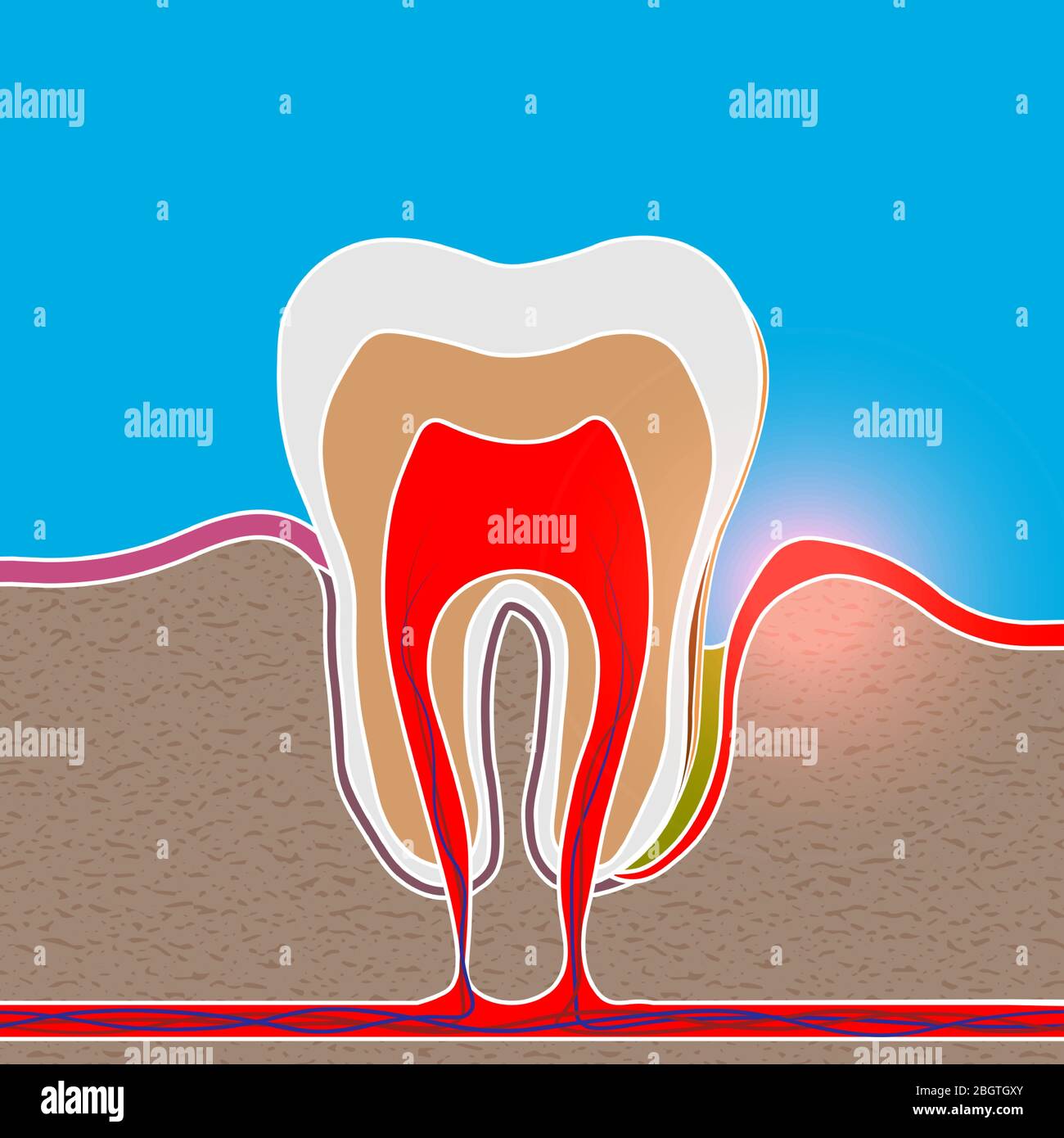 root inflammation, Gum disease, pus in the gum pocket, plaque and