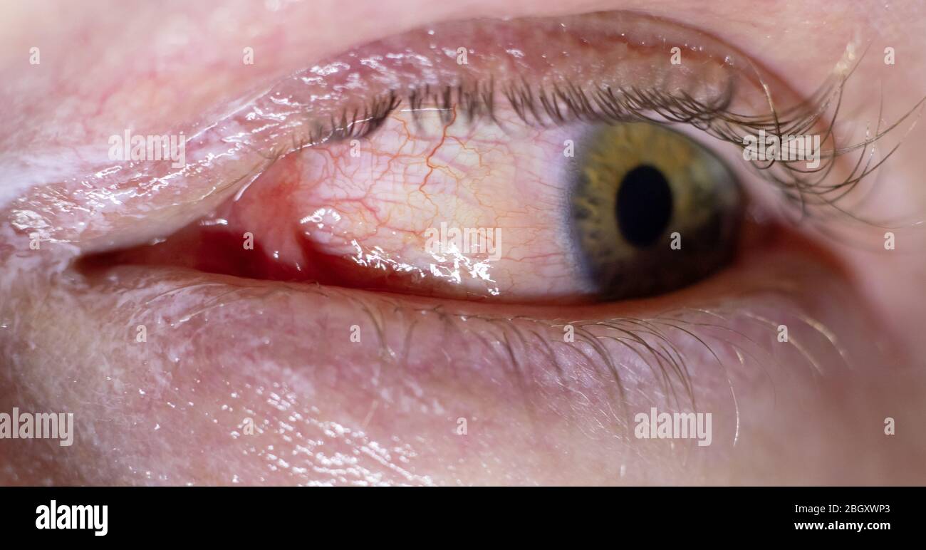 Pupula Duplex Cases