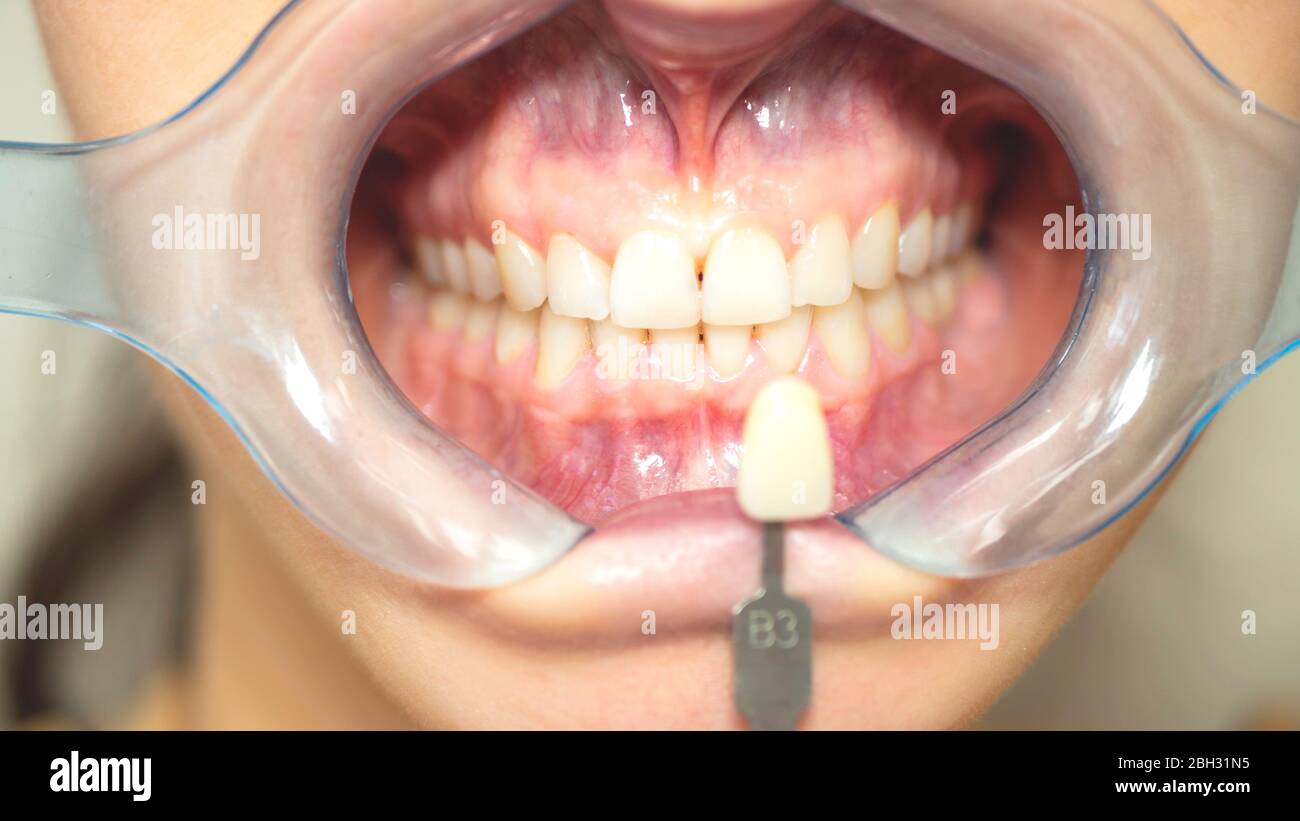 Dental mouth spreader, before teeth whitening Teeth woman at the