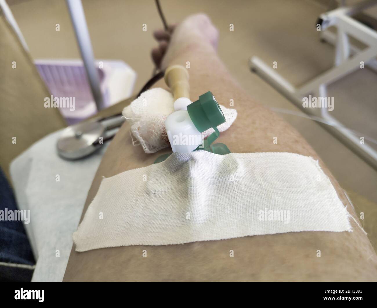 Blood transfusion. Intravenous catheter in the patient's hand Stock Photo