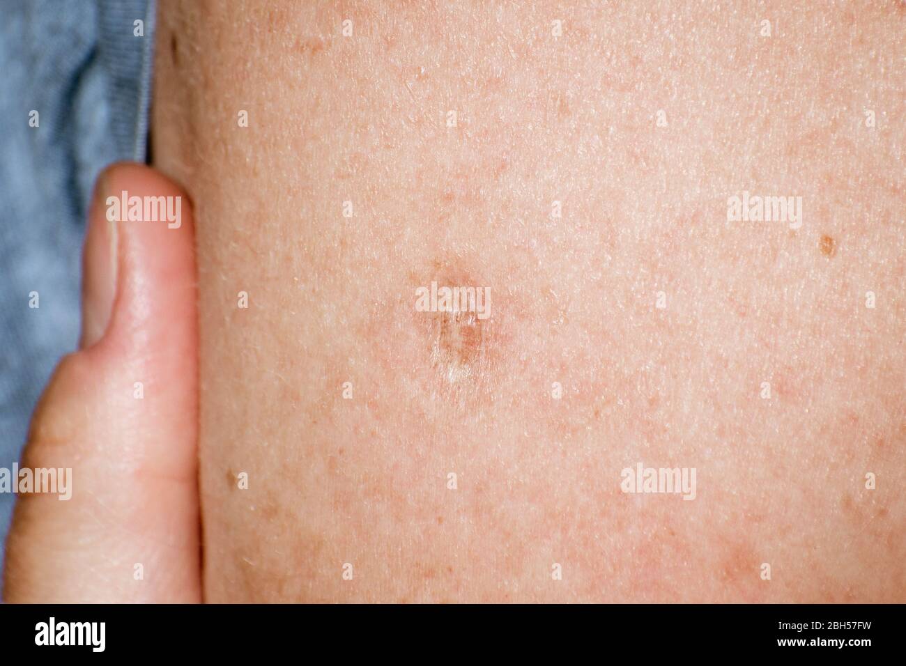 Close up of Bacillus Calmette-Guérin (BCG) vaccine scar mark in the upper left arm of an adult person; BCG vaccine is usually administered to newborns Stock Photo