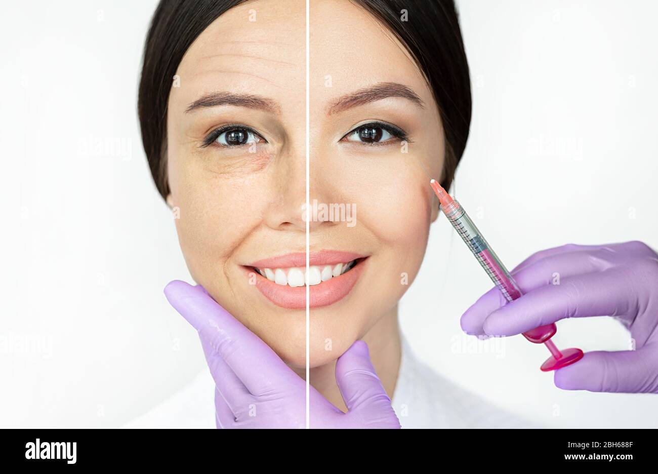 Comparison woman's face with wrinkle and smooth young face after beauty injections. Aged facial skin before and young lifting skin after procedure Stock Photo