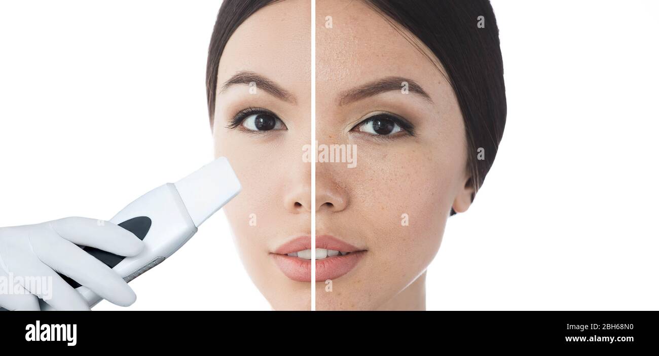 comparison face of beautiful woman with problem acne, and after procedure ultrasound peeling skin are clean. Ultrasound Cavitation face peel skin befo Stock Photo