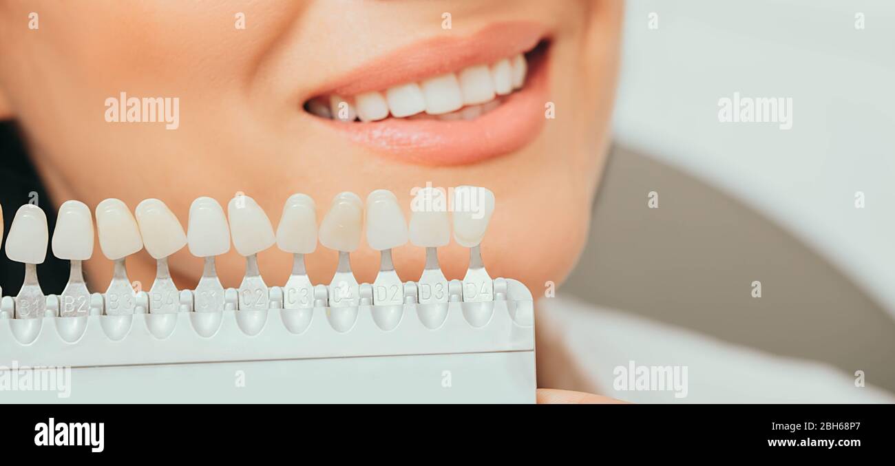 teeth palette with different shades of teeth near female smiling. Stomatology, whitening teeth, tooth implant Stock Photo