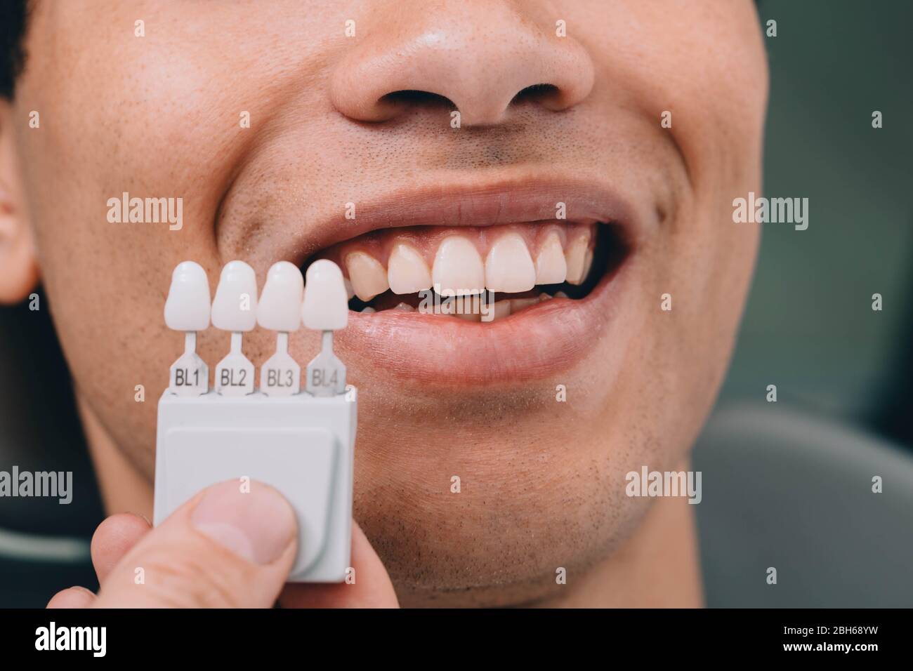 Dentist sampling shades teeth ,he holding teeth shades palette near male mouth. Whitening teeth Stock Photo