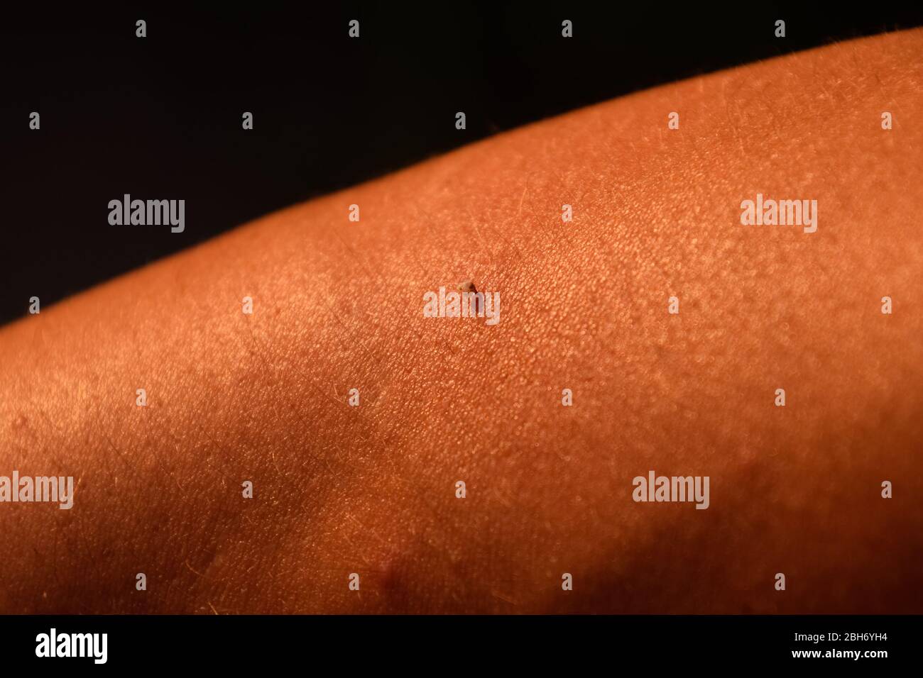 Bee sting. Bee sting in human skin. The consequences of stinging with bee venom. Stock Photo