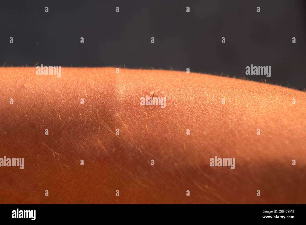 Bee Sting Skin High Resolution Stock Photography and Images Alamy