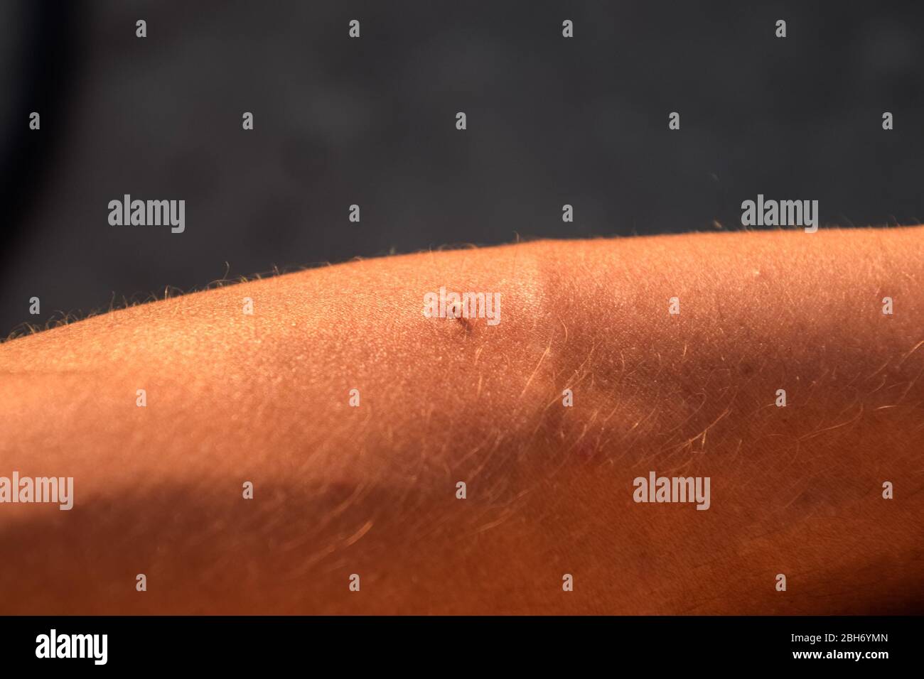 Bee sting. Bee sting in human skin. The consequences of stinging with