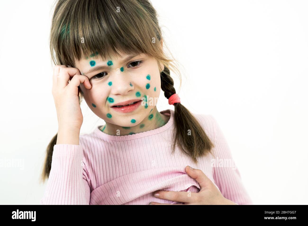 Child girl covered with green rashes on face ill with chickenpox, measles or rubella virus. Stock Photo