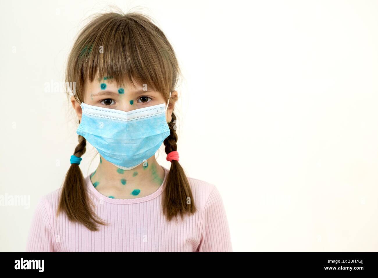 Child girl wearing blue protective medical mask ill with chickenpox, measles or rubella virus with rashes on body. Children protection during epidemic Stock Photo