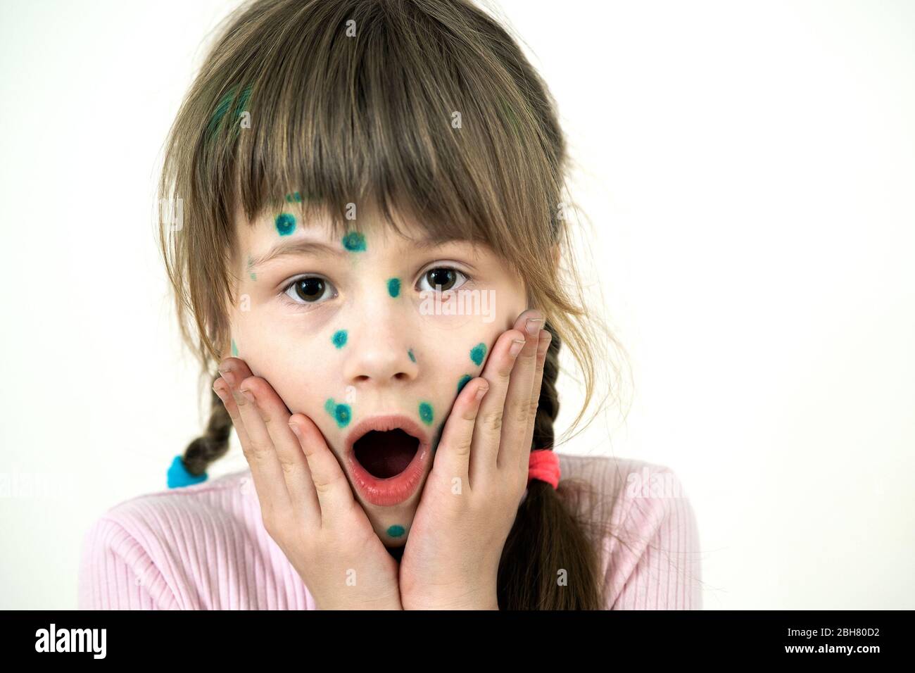 Child girl covered with green rashes on face ill with chickenpox, measles or rubella virus. Stock Photo