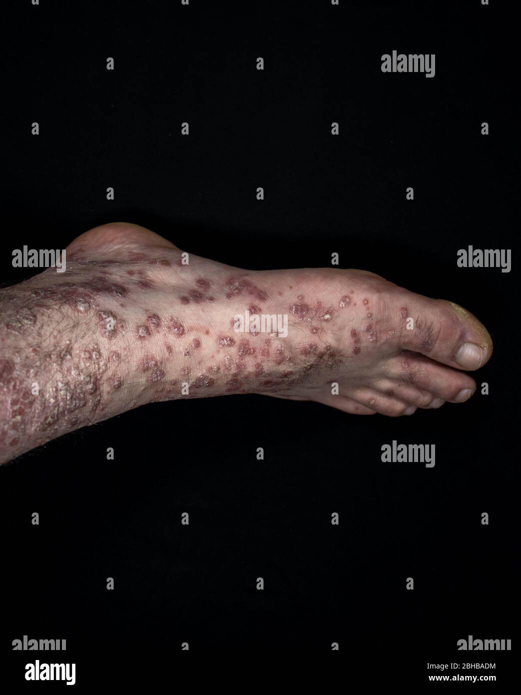 Psoriasis foot hi-res stock photography and images - Alamy