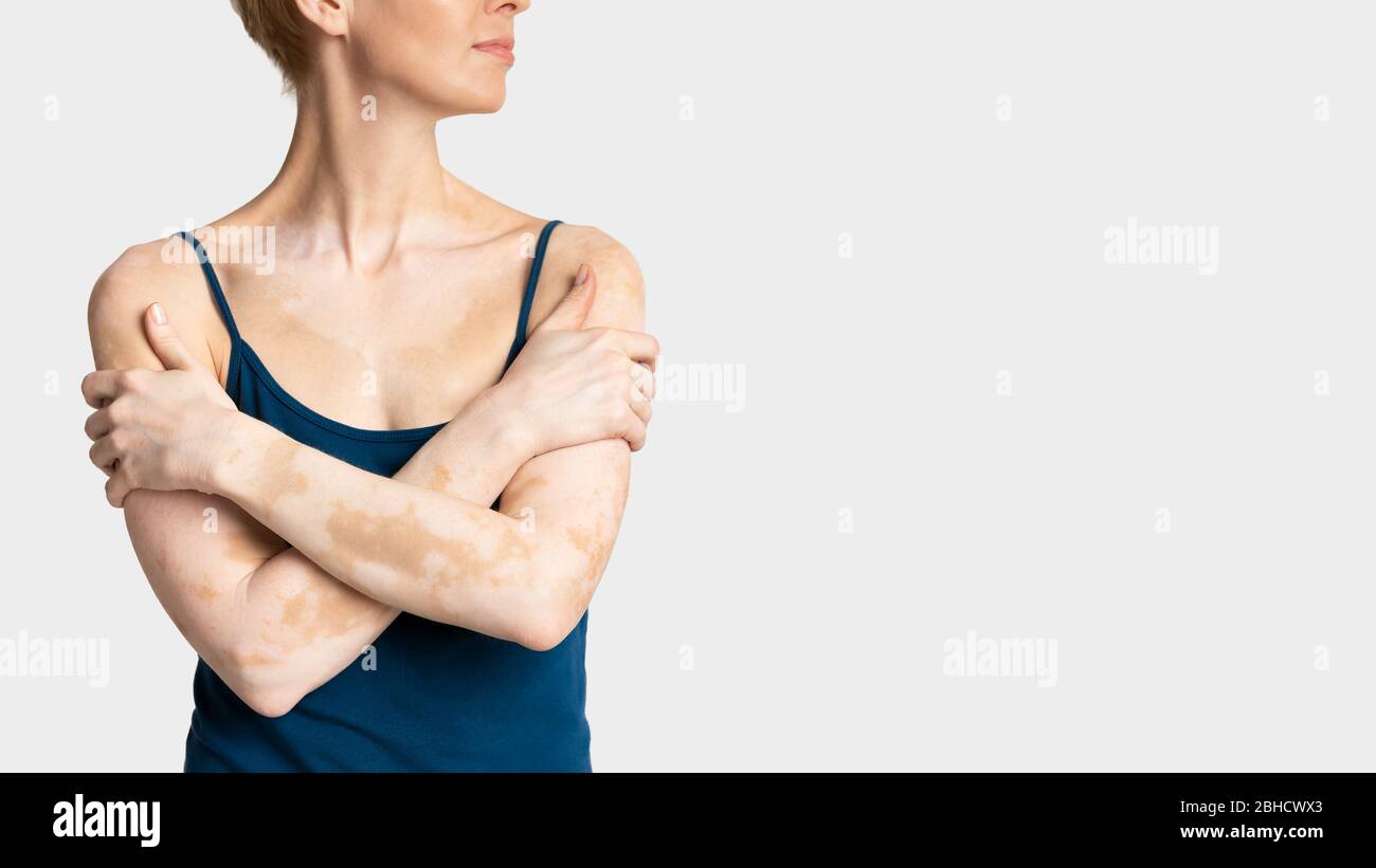 Patchy Color Patchy loss of skin color hi-res stock photography and images - Alamy