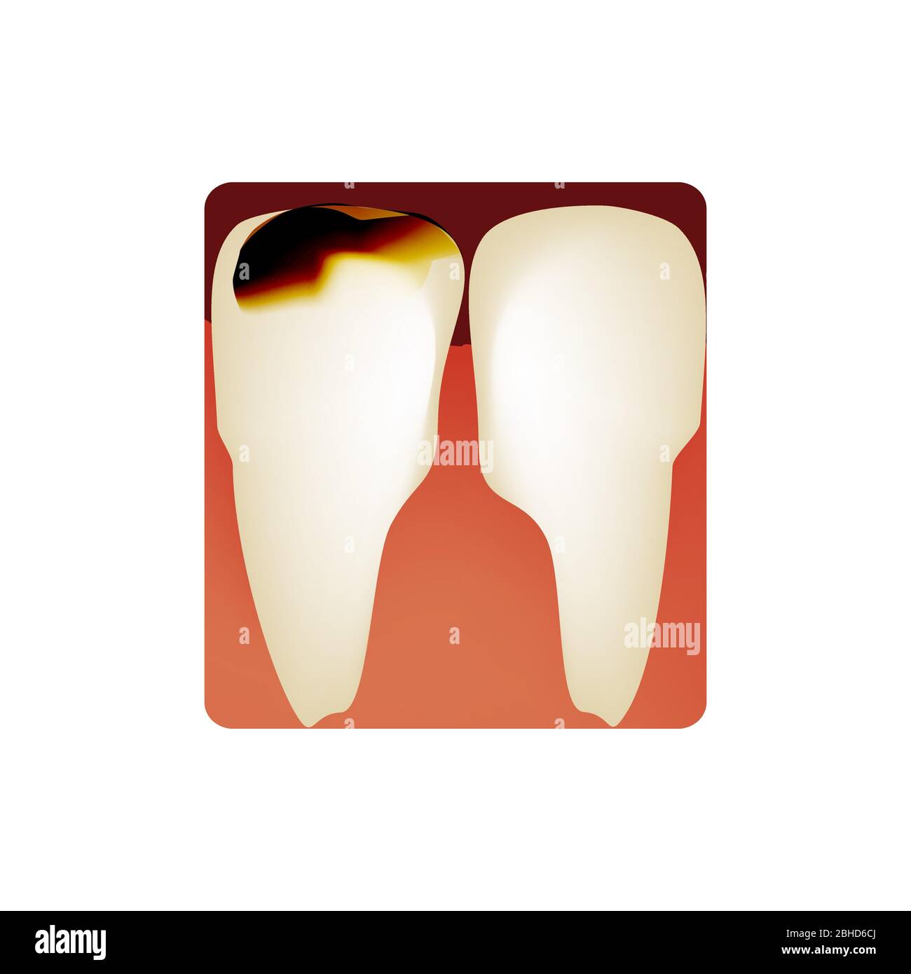 Dental caries. tooth decay. Caries infographics. Vector illustration on ...